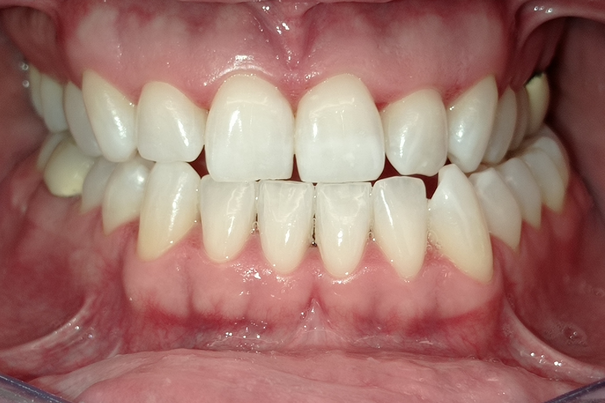 cover Λεύκανση