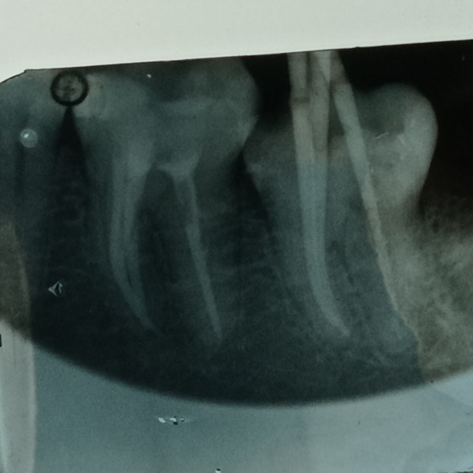 cover Ενδοδοντική Θεραπεία