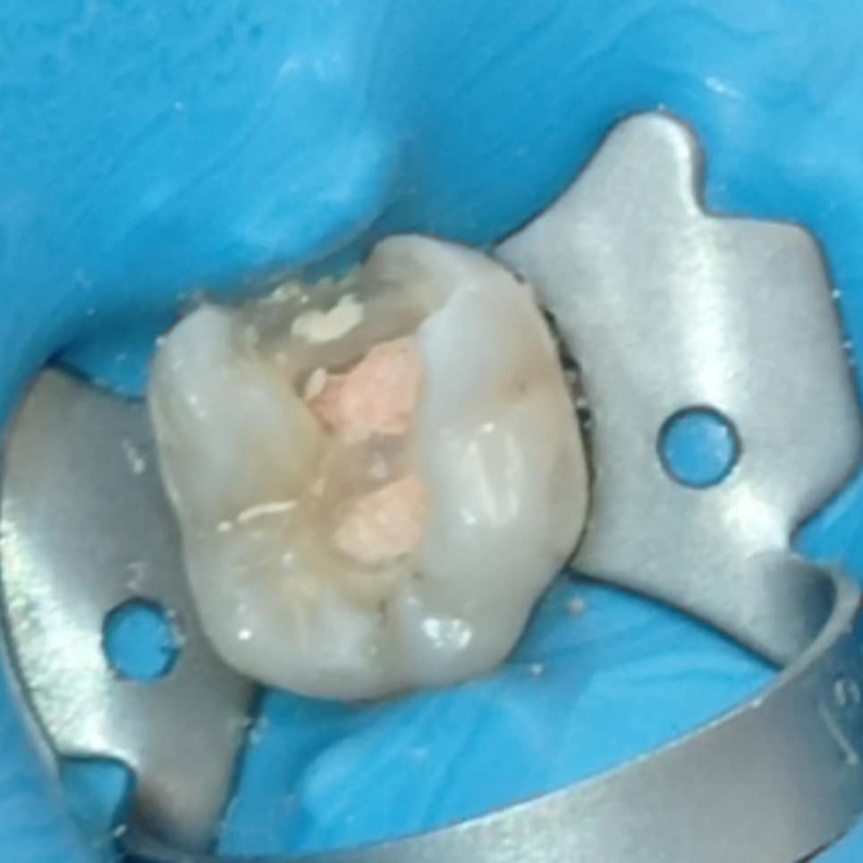 cover Ενδοδοντική Θεραπεία